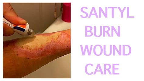2nd And 3rd Degree Burns Wound Care With Santyl Youtube