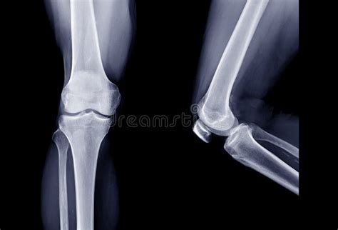 X Ray Image Of Right Knee Joint Ap View And Lateral View Stock Image