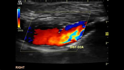 Cardio Vascular Ultrasound Carotid Doppler Vnus Closure Arterial