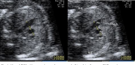 The Three Vessel View In The Fetal Mediastinum In The Diagnosis Of