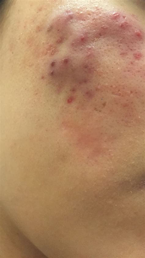 Dry Cystic Acne And Dans Regimen General Acne Discussion