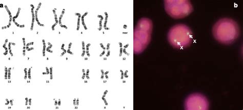 A Karyotype Of The Patient With Turner Syndrome B Interphase Fish