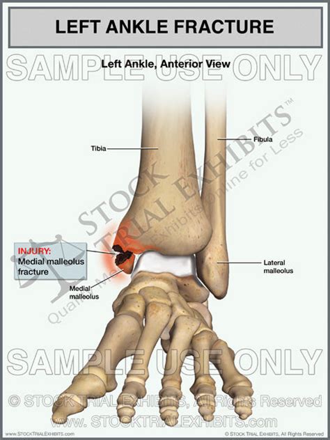Ankle Fracture Of The Left Medial Malleolus Fracture Stock Trial Exhibits