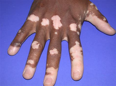 What Is Vitiligo Naturally Healthy Skin