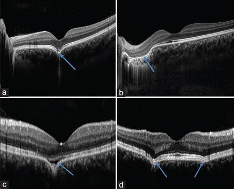 Morphological Features Of Focal Choroidal Excavation And Its
