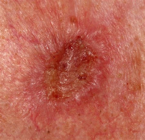 Red Skin Cancer Lesions