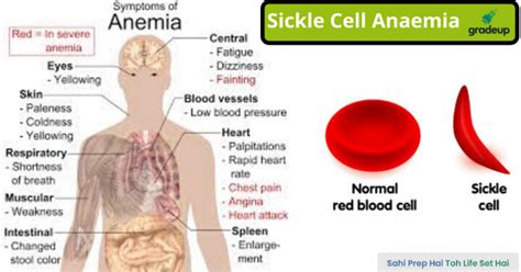 Know All About Sickle Cell Anemia Upsc Exams