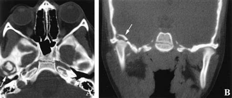 Fracture Of Glenoid Fossa And Traumatic Dislocation Of Mandibular