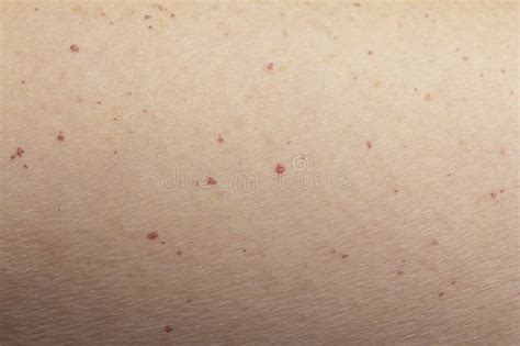121 Blood Spots Skin Stock Photos Free And Royalty Free Stock Photos