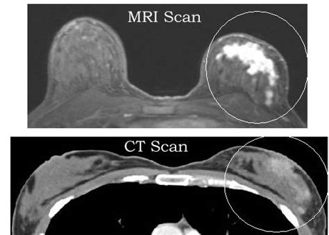 Some people refer to a ct scan as a cat scan. Breast Cancer Imaging