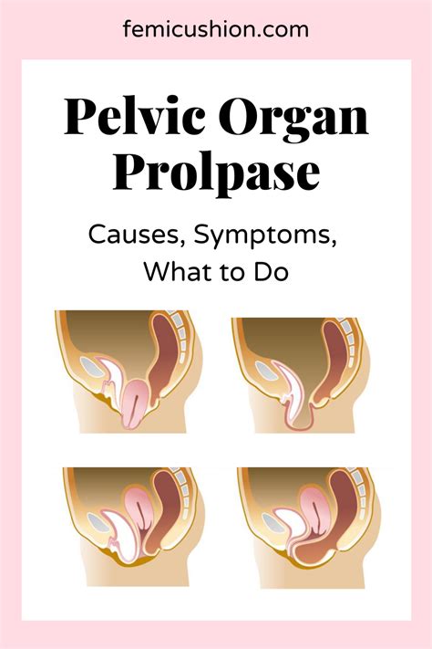 How Can I Tell What Type Of Prolapse I Have Types Of Pelvic Organ