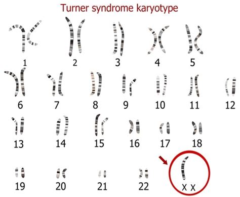 Turner Syndrom Zeichen Und Anzeichen
