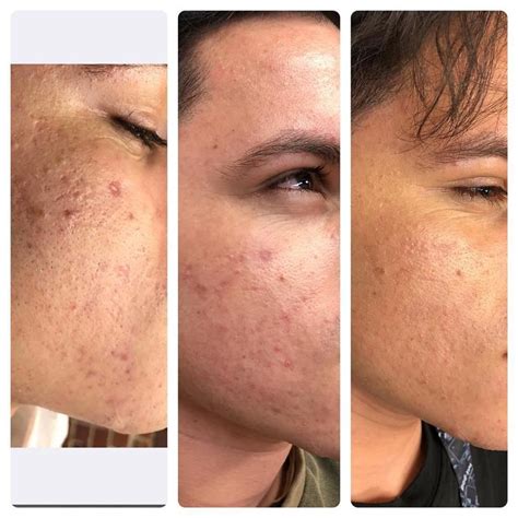 Prp Acne Scar Treatment Cosmetic And Laser Center