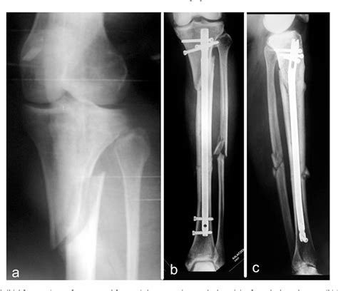 Figure 1 From Proximal Tibia Fractures And Intramedullary Nailing The