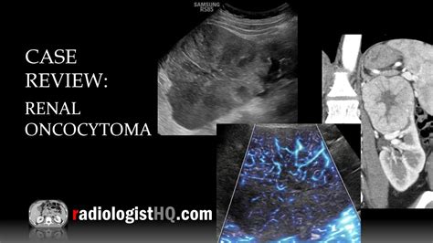 Case Review Ultrasound And Ct Of Renal Oncocytoma Youtube
