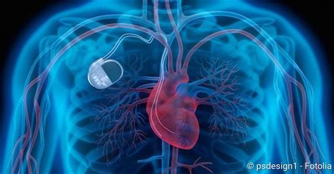 Herzschrittmacher Gründe Funktion Ablauf Netdoktor