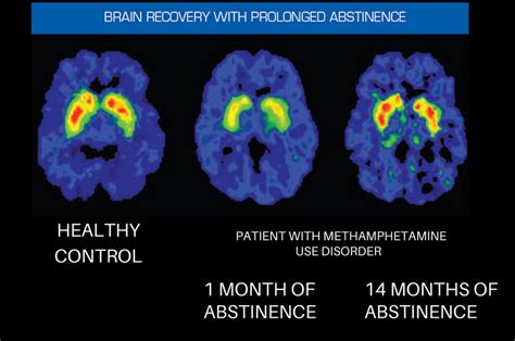 The Brain In Recovery Recovery Research Institute