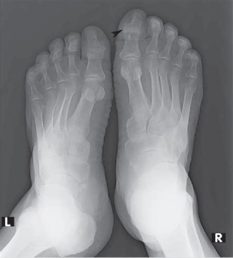 Figure 1 From Psoriatic Arthritis Imaging An Overview And Update