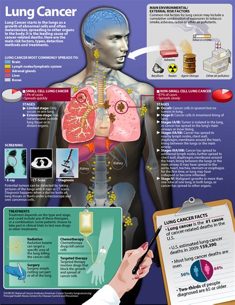 Lung Cancer Causes Info Graphic