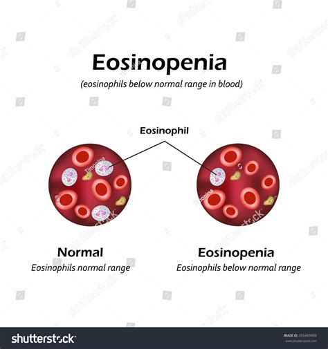 Eosinophils Below Normal Range Blood Eosinopenia Stock Vector 355493909
