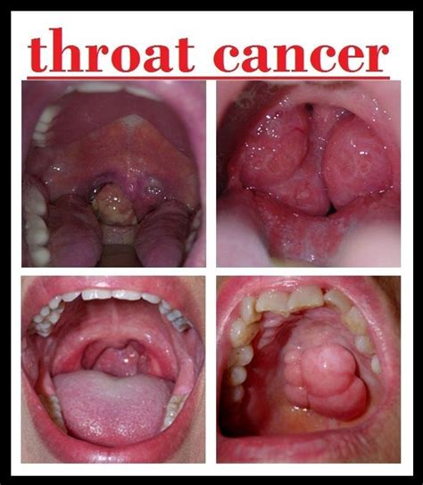 Cancer Of Throat And Neck Cancer News Update