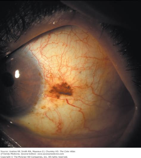 Scleral And Conjunctival Pigmentation Basicmedical Key