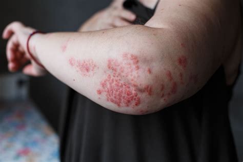 Is Psoriasis A Risk Factor For Cardiometabolic Disease In Women