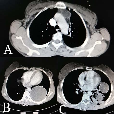 Thoracic Ct Scan Reveals A A 003 × 007 M Cyst In The Upper