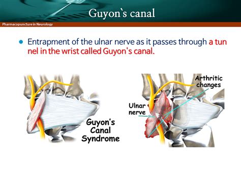 포착신경병증 상지 Guyon Canal Syndrome