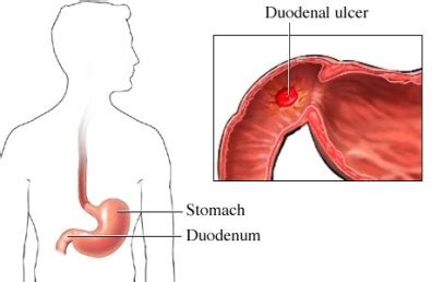Duodenal Ulcer MD Health Com