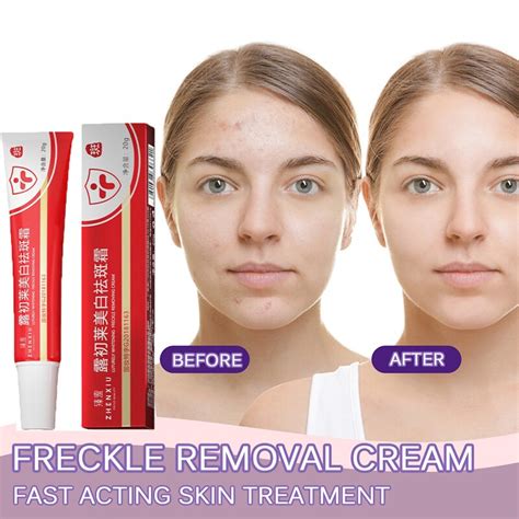 Zhenxiu Whitening And Freckle Removing Cream Brighten Fade Dark Spot
