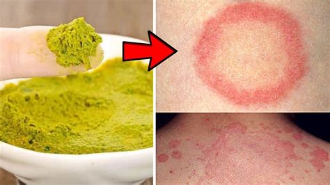 Get Rid Of Ringworm Fast And Permanently On Humans Face With This