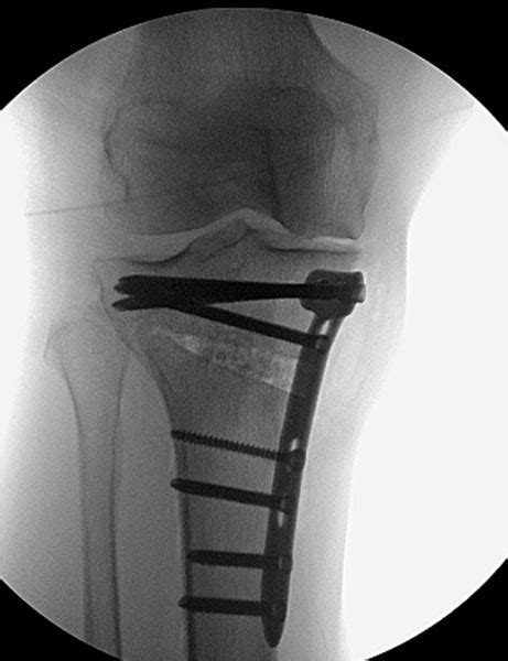 Knee Realignment And Joint Preservation Prox Tibial Osteotomy