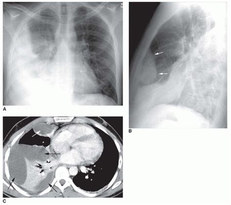 Commonly from congestive heart failure or malignancy. The Pleura and Pleural Disease | Radiology Key