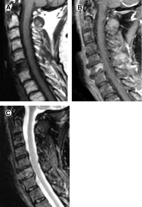 Partial Collapse Of C6 Vertebra In A 58 Year Old Woman With Breast