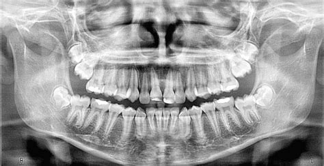 The Importance Of Dental X Rays Miller Hill Dental