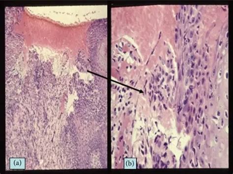 What Are Aphthous Ulcers Pathosomes