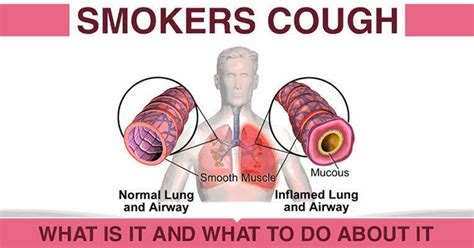 What Is Smokers Cough Cure For Sure