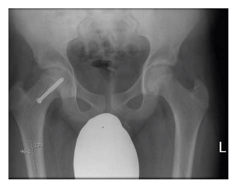 Neck Shaft Angle A Longitudinal Line Is Drawn Down The Centre Of The