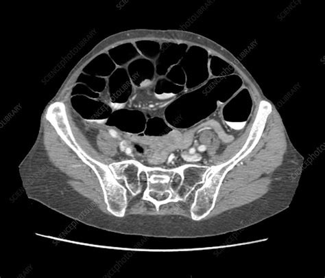 Rectal Cancer Ct Scan