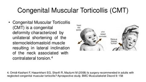 Pediatric Torticollis