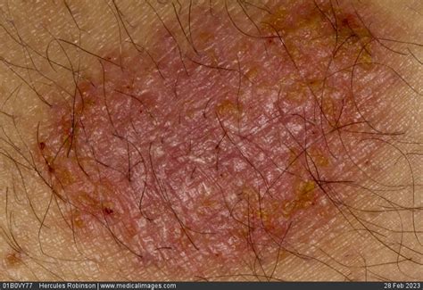 Stock Image Discoid Eczema Nummular Eczema On A 56 Year Old Male