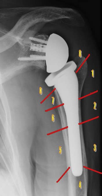 The Incidence Of Radiographic Aseptic Loosening Of The Humeral