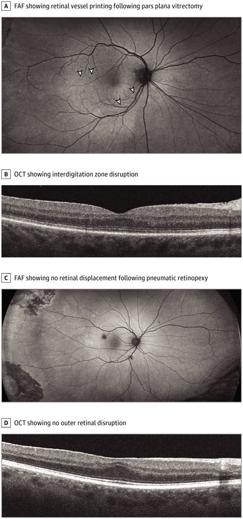 Retinal Displacement Following Pneumatic Retinopexy Vs Pars Plana