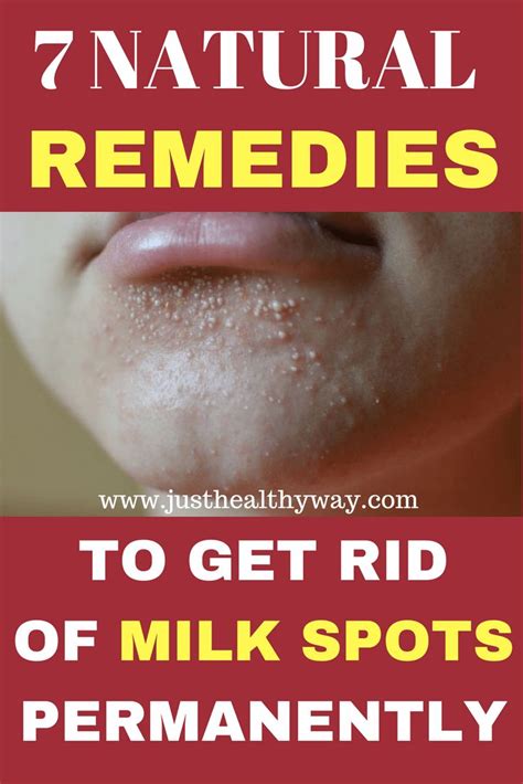 7 Natural Remedies To Get Rid Of Milk Spots Permanently Just Healthy