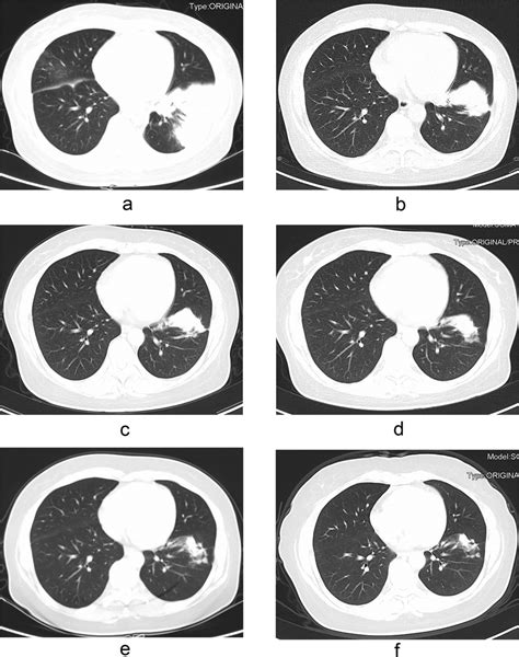Pulmonary Cryptococcosis In A 42 Year Old Woman With Nephrotic Syndrome