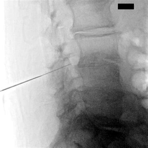 Lumbar Puncture Performed Using Atraumatic Pencil Tip Needle With