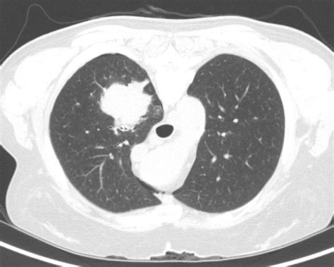 Determination Of Chest Wall Invasion In Lung Cancer By Ct