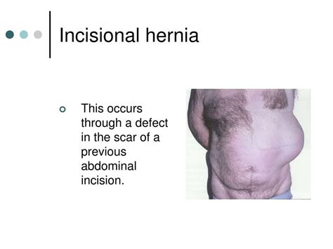 Ppt Abdominal Wall Abscess After Incisional Hernia Repair Powerpoint