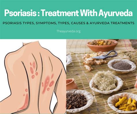 Psoriasis Symptoms Causes Types And Ayurveda Treatment Theayurveda